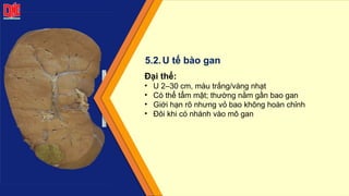 Đại thể:
• U 2–30 cm, màu trắng/vàng nhạt
• Có thể tẩm mật; thường nằm gần bao gan
• Giới hạn rõ nhưng vỏ bao không hoàn chỉnh
• Đôi khi có nhánh vào mô gan
5.2.U tế bào gan
 