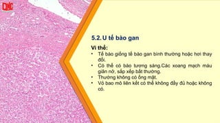 Vi thể:
• Tế bào giống tế bào gan bình thường hoặc hơi thay
đổi.
• Có thể có bào tương sáng.Các xoang mạch máu
giãn nở, sắp xếp bất thường.
• Thường không có ống mật.
• Vỏ bao mô liên kết có thể không đầy đủ hoặc không
có.
5.2.U tế bào gan
 