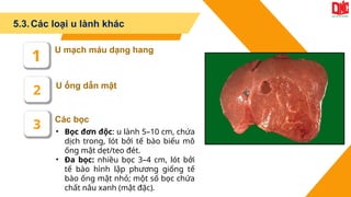 5.3.Các loại u lành khác
Các bọc
U ống dẫn mật
U mạch máu dạng hang
1
2
3 • Bọc đơn độc: u lành 5–10 cm, chứa
dịch trong, lót bởi tế bào biểu mô
ống mật dẹt/teo đét.
• Đa bọc: nhiều bọc 3–4 cm, lót bởi
tế bào hình lập phương giống tế
bào ống mật nhỏ; một số bọc chứa
chất nâu xanh (mật đặc).
 