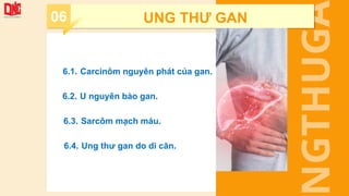 NGTHUGA
6.1. Carcinôm nguyên phát của gan.
6.2. U nguyên bào gan.
6.3. Sarcôm mạch máu.
6.4. Ung thư gan do di căn.
06 UNG THƯ GAN
 