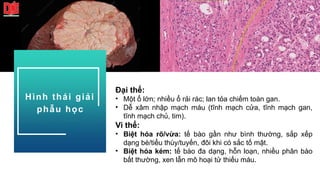 Đại thể:
• Một ổ lớn; nhiều ổ rải rác; lan tỏa chiếm toàn gan.
• Dễ xâm nhập mạch máu (tĩnh mạch cửa, tĩnh mạch gan,
tĩnh mạch chủ, tim).
Vi thể:
• Biệt hóa rõ/vừa: tế bào gần như bình thường, sắp xếp
dạng bè/tiểu thùy/tuyến, đôi khi có sắc tố mật.
• Biệt hóa kém: tế bào đa dạng, hỗn loạn, nhiều phân bào
bất thường, xen lẫn mô hoại tử thiếu máu.
Hình thái giải
phẫu học
 
