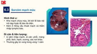 6.3 Sarcôm mạch máu
Hình thái u:
• Khe mạch chứa máu, lót bởi tế bào nội
mô dẹp hoặc tế bào đa diện.
• Kèm ổ hồng cầu thoát mạch và thấm
nhập lympho bào.
Di căn & tiên lượng:
• U xâm nhập mạnh, di căn: phổi, màng
phổi, lách, hạch, xương, các nơi khác.
• Thường gây tử vong trong vòng 1 năm
 