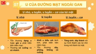 U nhú U tuyến U tuyến - cơ
• Tổn thương dạng u
hoặc giả u phát triển
trên niêm mạc.
• Thường có cuống và
có nhánh.
• Khối u biểu mô lành
tính, phát triển trên
niêm mạc.
• Tổn thương dày,
phẳng, không có
cuống.
• Tăng sinh, dày thành với
sự hình thành các túi nhỏ
trong mô thành túi mật.
07 U CỦA ĐƯỜNG MẬT NGOÀI GAN
U nhú, u tuyến, u tuyến – cơ của túi mật
 