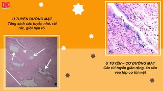 U TUYẾN ĐƯỜNG MẬT
Tăng sinh các tuyến nhỏ, rải
rác, giới hạn rõ
U TUYẾN – CƠ ĐƯỜNG MẬT
Các túi tuyến giãn rộng, ăn sâu
vào lớp cơ túi mật
 