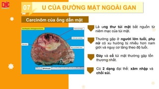 Add title!
07 U CỦA ĐƯỜNG MẬT NGOÀI GAN
Carcinôm của ống dẫn mật
Là ung thư túi mật bắt nguồn từ
niêm mạc của túi mật.
Thường gặp ở người lớn tuổi, phụ
nữ có xu hướng bị nhiều hơn nam
giới và nguy cơ tăng theo độ tuổi.
Đáy và cổ túi mật thường gặp tổn
thương nhất.
Có 2 dạng đại thể: xâm nhập và
chồi sùi.
 