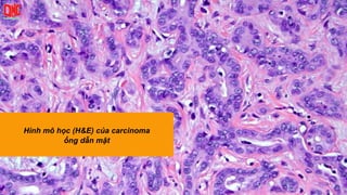 Hình mô học (H&E) của carcinoma
ống dẫn mật
 