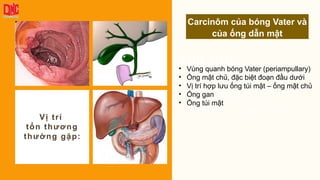 Add title!
Lorem ipsum dolor sit amet,
consectetuer adipiscing elit. Maecenas
porttitor congue massa. Fusce posuere,
magna sed pulvinar ultricies, purus lectus
malesuada libero, sit amet commodo
magna eros quis urna.
Vị trí
tổn thương
thường gặp:
• Vùng quanh bóng Vater (periampullary)
• Ống mật chủ, đặc biệt đoạn đầu dưới
• Vị trí hợp lưu ống túi mật – ống mật chủ
• Ống gan
• Ống túi mật
Carcinôm của bóng Vater và
của ống dẫn mật
 