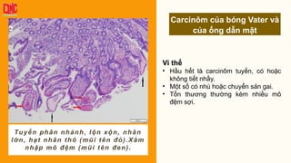 Vi thể
• Hầu hết là carcinôm tuyến, có hoặc
không tiết nhầy.
• Một số có nhú hoặc chuyển sản gai.
• Tổn thương thường kèm nhiều mô
đệm sợi.
Carcinôm của bóng Vater và
của ống dẫn mật
Tuyến phân nhánh, lộn xộn, nhân
lớn, hạt nhân thô (mũi tên đỏ).Xâm
nhập mô đệm (mũi tên đen).
 