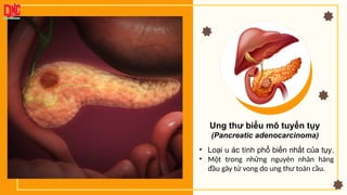 Ung thư biểu mô tuyến tụy
(Pancreatic adenocarcinoma)
• Loại u ác tính phổ biến nhất của tụy.
• Một trong những nguyên nhân hàng
đầu gây tử vong do ung thư toàn cầu.
 
