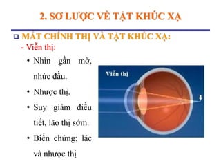 2. SƠ LƢỢC VỀ TẬT KHÚC XẠ
 MẮT CHÍNH THỊ VÀ TẬT KHÚC XẠ:
- Viễn thị:
• Nhìn gần mờ,
nhức đầu.
• Nhược thị.
• Suy giảm điều
tiết, lão thị sớm.
• Biến chứng: lác
và nhược thị
 