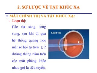 2. SƠ LƢỢC VỀ TẬT KHÚC XẠ
 MẮT CHÍNH THỊ VÀ TẬT KHÚC XẠ:
- Loạn thị:
Các tia sáng song
song, sau khi đi qua
hệ thống quang học
mắt sẽ hội tụ trên ≥ 2
đường thẳng nằm trên
các mặt phẳng khác
nhau gọi là tiêu tuyến.
 