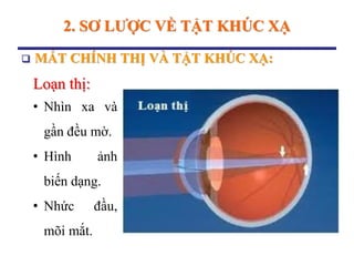 2. SƠ LƢỢC VỀ TẬT KHÚC XẠ
 MẮT CHÍNH THỊ VÀ TẬT KHÚC XẠ:
Loạn thị:
• Nhìn xa và
gần đều mờ.
• Hình ảnh
biến dạng.
• Nhức đầu,
mõi mắt.
 