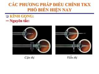 CÁC PHƢƠNG PHÁP ĐIỀU CHỈNH TKX
PHỔ BIẾN HIỆN NAY
 KÍNH GỌNG:
─ Nguyên tắc:
Cận thị Viễn thị
 