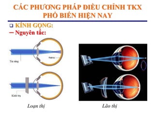 CÁC PHƢƠNG PHÁP ĐIỀU CHỈNH TKX
PHỔ BIẾN HIỆN NAY
 KÍNH GỌNG:
─ Nguyên tắc:
Lão thịLoạn thị
 