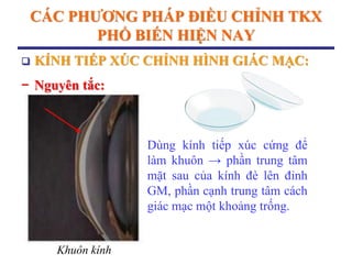 CÁC PHƢƠNG PHÁP ĐIỀU CHỈNH TKX
PHỔ BIẾN HIỆN NAY
 KÍNH TIẾP XÚC CHỈNH HÌNH GIÁC MẠC:
− Nguyên tắc:
Khuôn kính
Dùng kính tiếp xúc cứng để
làm khuôn → phần trung tâm
mặt sau của kính đè lên đỉnh
GM, phần cạnh trung tâm cách
giác mạc một khoảng trống.
 