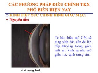 CÁC PHƢƠNG PHÁP ĐIỀU CHỈNH TKX
PHỔ BIẾN HIỆN NAY
 KÍNH TIẾP XÚC CHỈNH HÌNH GIÁC MẠC:
− Nguyên tắc:
Tế bào biểu mô GM sẽ
tăng sinh dần dần để lắp
đầy khoảng trống giữa
mặt sau kính và nhu mô
giác mạc cạnh trung tâm.
Khi mang kính
 