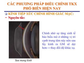 CÁC PHƢƠNG PHÁP ĐIỀU CHỈNH TKX
PHỔ BIẾN HIỆN NAY
 KÍNH TIẾP XÚC CHỈNH HÌNH GIÁC MẠC:
− Nguyên tắc:
Sau mang kính
Chính nhờ sự tăng sinh tế
bào biều mô ở những vị trí
cạnh trung tâm này nên sau
lấy kính ra GM sẽ dẹt
hơn→ thay đổi độ khúc xạ.
 