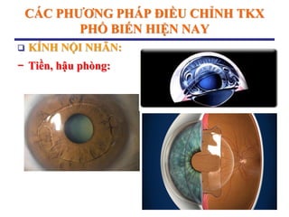 CÁC PHƢƠNG PHÁP ĐIỀU CHỈNH TKX
PHỔ BIẾN HIỆN NAY
 KÍNH NỘI NHÃN:
− Tiền, hậu phòng:
 