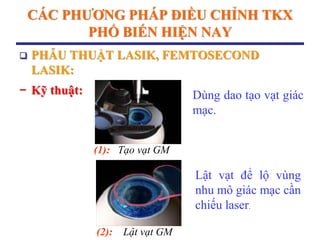 CÁC PHƢƠNG PHÁP ĐIỀU CHỈNH TKX
PHỔ BIẾN HIỆN NAY
 PHẪU THUẬT LASIK, FEMTOSECOND
LASIK:
− Kỹ thuật:
(1): Tạo vạt GM
(2): Lật vạt GM
Dùng dao tạo vạt giác
mạc.
Lật vạt để lộ vùng
nhu mô giác mạc cần
chiếu laser.
 