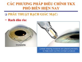 CÁC PHƢƠNG PHÁP ĐIỀU CHỈNH TKX
PHỔ BIẾN HIỆN NAY
 PHẪU THUẬT RẠCH GIÁC MẠC:
− Rạch dãn rìa:
 
