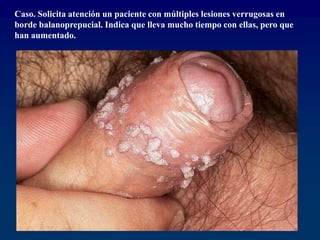 Caso. Solicita atención un paciente con múltiples lesiones verrugosas en
borde balanoprepucial. Indica que lleva mucho tiempo con ellas, pero que
han aumentado.
 