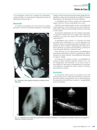 Relato de Caso
Gaia e cols.
Tratamento endovascular da PCA
Arq Bras Cardiol 2008;91(2): e17 - e19
Fig. 1 -Ressonância nuclear magnética evidenciando a persistência do canal
arterial (seta).
Fig. 2 - A - Radiografia de tórax evidenciando o posicionamento e expansão da endoprótese; B - Ecocardiograma transesofágico evidenciando boa coaptação da
endoprótese e exclusão do canal arterial.
e ecocardiograma revelou boa coaptação da endoprótese,
ausência de fluxo no canal arterial e regressão dos sinais de
hipertensão pulmonar (fig. 2).
Discussão
O achado da persistência do canal arterial em adultos
permanece como uma controvérsia terapêutica. A intervenção
cirúrgicaconvencionalnessafaixaetáriaenvolvesignificativorisco
operatório, muitas vezes necessitando do auxílio de circulação
extracorpórea e de interposição de enxertos sintéticos3
.
A mortalidade dessa doença quando não tratada pode
chegar a 20% aos 30 anos, aumentando 4% ao ano4
.
Indivíduos não tratados podem evoluir com hipertensão
arterial pulmonar, risco de dissecção de artéria pulmonar,
endocardite, síndrome de Eisenmenger, disfunção ventricular
e morte súbita4
.
Em razão das complicações e do risco cirúrgico aumentado,
o tratamento endovascular tem surgido como alternativa
terapêutica, por meio da exclusão do orifício aórtico do
canal arterial1,2,5,6
.
A abordagem mais comum é a colocação de molas
na tentativa de embolização ou o uso de dispositivos de
Amplatzer. Porém, estes apresentam diversas limitações como
presença de shunts residuais, embolização das molas para a
árvore pulmonar ou sistema arterial periférico, presença de
canais de grande diâmetro e rotura do canal2
.
Neste relato de caso, fica demonstrada a possibilidade de
intervenção endovascular, inclusive na presença de calibres
reduzidos da artéria femoral. O procedimento demonstrou
ser seguro e simples.
As limitações do método incluem a possibilidade de
oclusão da artéria subclávia esquerda, mesmo com o uso
de endopróteses não-revestidas no seu terço inicial, a
necessidade de intervenção transabdominal em pacientes
com diâmetros reduzidos de artéria femoral ou doença
aterosclerótica avançada.
Conclusão
O tratamento endovascular da persitência do canal
arterial pode tornar-se a alternativa de primeira escolha em
pacientes adultos, principalmente com o desenvolvimento
de dispositivos de perfil mais favorável e navegabilidade
aórtica aumentada.
e18
 