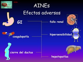 AINEs
AINEs
Efectos adversos
GI
coagulopatía
cierre del ductus
hipersensibilidad
fallo renal
hepatopatías
 