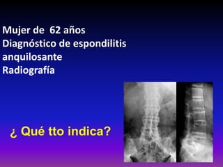 Mujer de 62 años
Diagnóstico de espondilitis
anquilosante
Radiografía
¿ Qué tto indica?
 