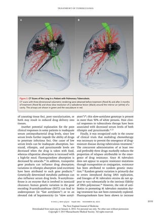 n engl j med 373;22 nejm.org November 26, 2015 2151
Treatment of Tuberculosis
of caseating tissue foci, poor vascularization, or
both may result in reduced drug delivery into
tissues.
Another potential explanation for the poor
clinical responses in some patients is inadequate
serum antimycobacterial drug levels, since low
serum levels further impede the ability of drugs
to penetrate infectious foci. One cause of low
serum levels can be inadequate absorption. Iso-
niazid, rifampin, and pyrazinamide levels are
decreased when the drug is taken with food,
whereas rifapentine absorption is increased with
a high-fat meal; fluoroquinolone absorption is
decreased by antacids.18
In addition, transporter
gene products can influence drug absorption;
variations in rifampin absorption (and excretion)
have been attributed to such gene products.19
Genetically determined metabolic pathways can
also influence serum drug levels. N-acetyltrans-
ferase is an enzyme that is involved in isoniazid
clearance; human genetic variation in the gene
encoding N-acetyltransferase (NAT2) can lead to
underexposure (in “fast acetylators”) or to an
elevated risk of hepatotoxicity (in “slow acetyl-
ators”)20
; this slow-acetylator genotype is present
in more than 50% of white persons. Poor clini-
cal responses to tuberculosis therapy have been
associated with decreased serum levels of both
rifampin and pyrazinamide.21,22
Finally, it was recognized early in the course
of clinical trials that multidrug chemotherapy
was necessary to prevent the emergence of drug-
resistant disease during tuberculosis treatment.2
The concurrent administration of at least two
and preferably three drugs markedly reduces the
proportion of relapses attributable to the emer-
gence of drug resistance. Since M. tuberculosis
does not appear to acquire resistance mutations
through transposition or conjugation, resistance
has been attributed to random genetic muta-
tion.23
Random genetic variation is primarily due
to errors introduced during DNA replication,
and lineages of M. tuberculosis strains do not ap-
pear to vary substantially in the intrinsic fidelity
of DNA polymerase.24
However, the role of anti-
biotics in promoting M. tuberculosis mutation dur-
ing treatment has not been extensively explored.
Fluoroquinolones have been shown to increase
Figure 2. CT Scans of the Lung in a Patient with Pulmonary Tuberculosis.
CT scans with three­dimensional volumetric rendering were obtained before treatment (Panel A) and after 2 months
of treatment (Panel B) and show slow resolution of a radiodense lesion (black) around the interior air (white) of a
cavity. The airways are shown in green and the vasculature in red.
A B
The New England Journal of Medicine
Downloaded from nejm.org on January 4, 2016. For personal use only. No other uses without permission.
Copyright © 2015 Massachusetts Medical Society. All rights reserved.
 