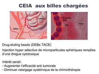 CEIA aux billes chargées
Drug-eluting beads (DEBs TACE)
Injection hyper sélective de microparticules sphériques remplies
d’une drogue cytotoxique
Intérêt serait :
- Augmenter l’efficacité anti tumorale
- Diminuer relargage systémique de la chimiothérapie
 