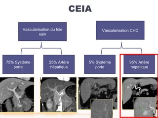 Vascularisation du foie
sain
Vascularisation CHC
5% Système
porte
95% Artère
hépatique
25% Artère
hépatique
75% Système
porte
CEIA
 