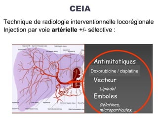 CEIA
Technique de radiologie interventionnelle locorégionale
Injection par voie artérielle +/- sélective :
Doxorubicine / cisplatine
 