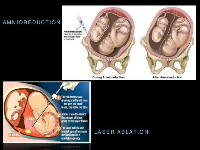 twin to twin transfusion syndrome twin twin transfusion