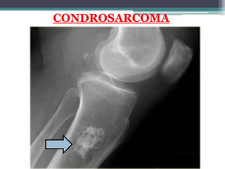 CONDROSARCOMA
 