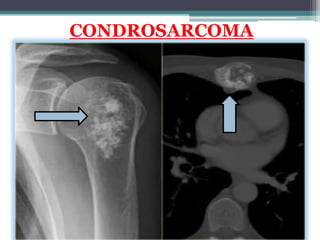 CONDROSARCOMA
 