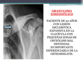 GRANULOMA
  EOSINOFÍLICO

PACIENTE DE 20 AÑOS
     CON LESIÓN
    ESCLERÓTICA
  EXPANSIVA EN LA
   CLAVÍCULA CON
 PEQUEÑAS...