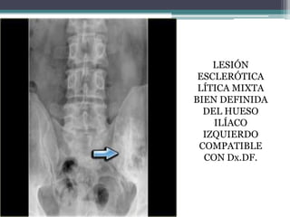 LESIÓN
 ESCLERÓTICA
 LÍTICA MIXTA
BIEN DEFINIDA
  DEL HUESO
    ILÍACO
  IZQUIERDO
 COMPATIBLE
  CON Dx.DF.
 