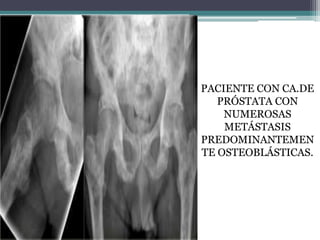 PACIENTE CON CA.DE
   PRÓSTATA CON
    NUMEROSAS
    METÁSTASIS
PREDOMINANTEMEN
TE OSTEOBLÁSTICAS.
 