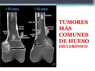 TUMORES
MÁS
COMUNES
DE HUESO
ESCLERÓTICO
 