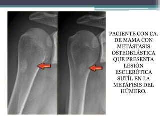 PACIENTE CON CA.
  DE MAMA CON
   METÁSTASIS
 OSTEOBLÁSTICA
 QUE PRESENTA
     LESIÓN
  ESCLERÓTICA
   SUTÍL EN LA
 METÁFI...