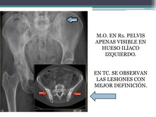 M.O. EN Rx. PELVIS
APENAS VISIBLE EN
  HUESO ILÍACO
   IZQUIERDO.


EN TC. SE OBSERVAN
 LAS LESIONES CON
MEJOR DEFINICIÓN.
 