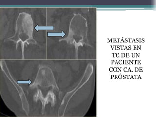 METÁSTASIS
 VISTAS EN
 TC.DE UN
 PACIENTE
CON CA. DE
 PRÓSTATA
 