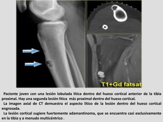 Paciente joven con una lesión lobulada lítica dentro del hueso cortical anterior de la tibia
proximal. Hay una segunda les...