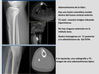 Adamantinoma de la tibia :
  Hay una lesión osteolítica ovoide
  dentro del hueso cortical anterior.
  T2 axial : muestra ...