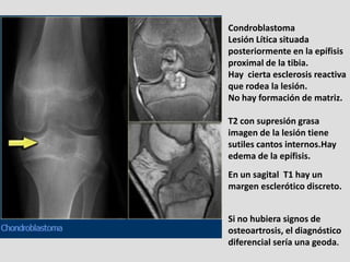 Condroblastoma
Lesión Lítica situada
posteriormente en la epífisis
proximal de la tibia.
Hay cierta esclerosis reactiva
qu...