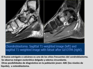 El hueso astrágalo o calcáneo es uno de los sitios frecuentes del condroblastoma.
 Se observa márgen esclerótico delgado y...