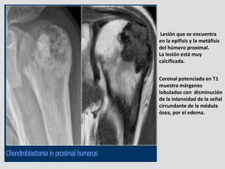 Lesión que se encuentra
en la epifisis y la metáfisis
del húmero proximal.
La lesión está muy
calcificada.


Coronal poten...