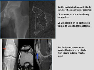 Lesión excéntrica bien definida de
carácter lítico en el fémur proximal.
CT muestra un borde lobulado y
esclerótico.

La u...