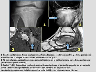 1- Condroblastoma con Típica localización epifisaria.Signos de esclerosis reactiva y edema perilesional
abundante en la im...