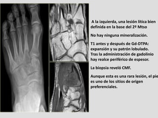 A la izquierda, una lesión lítica bien
definida en la base del 2º Mtso
No hay ninguna mineralización.
T1 antes y después d...